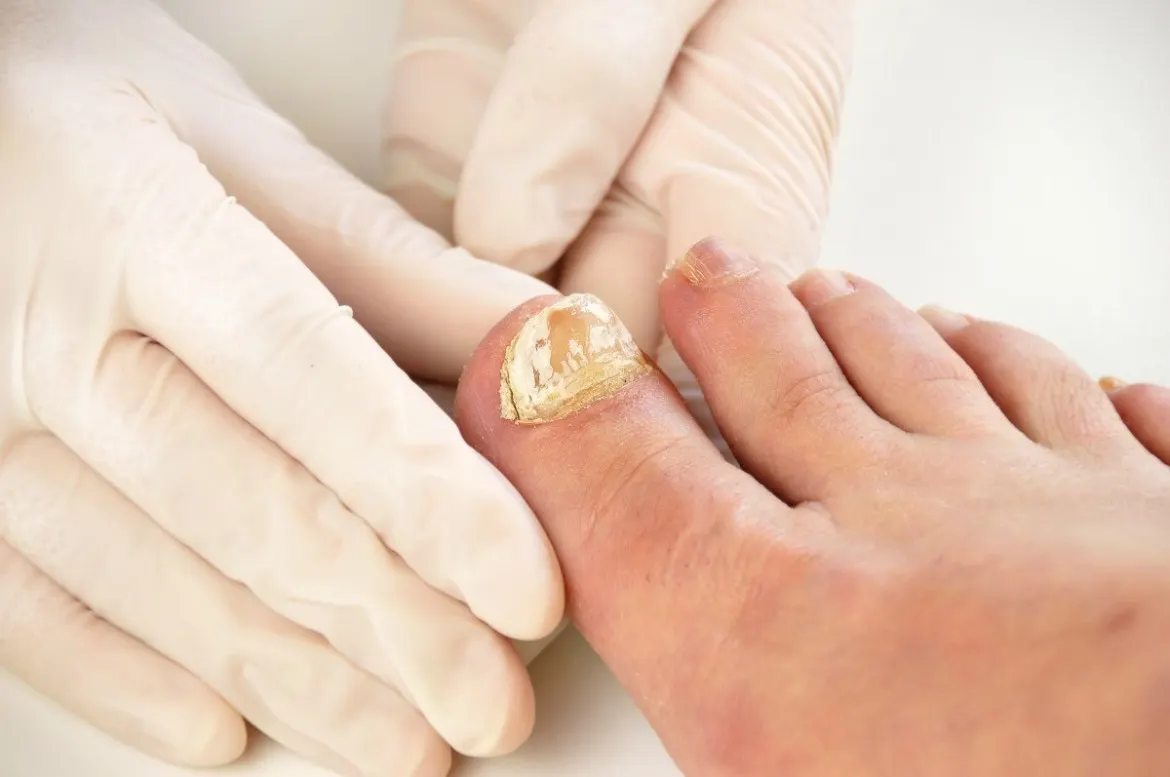 One Cup Of This Will Destroy Your Nail Fungus