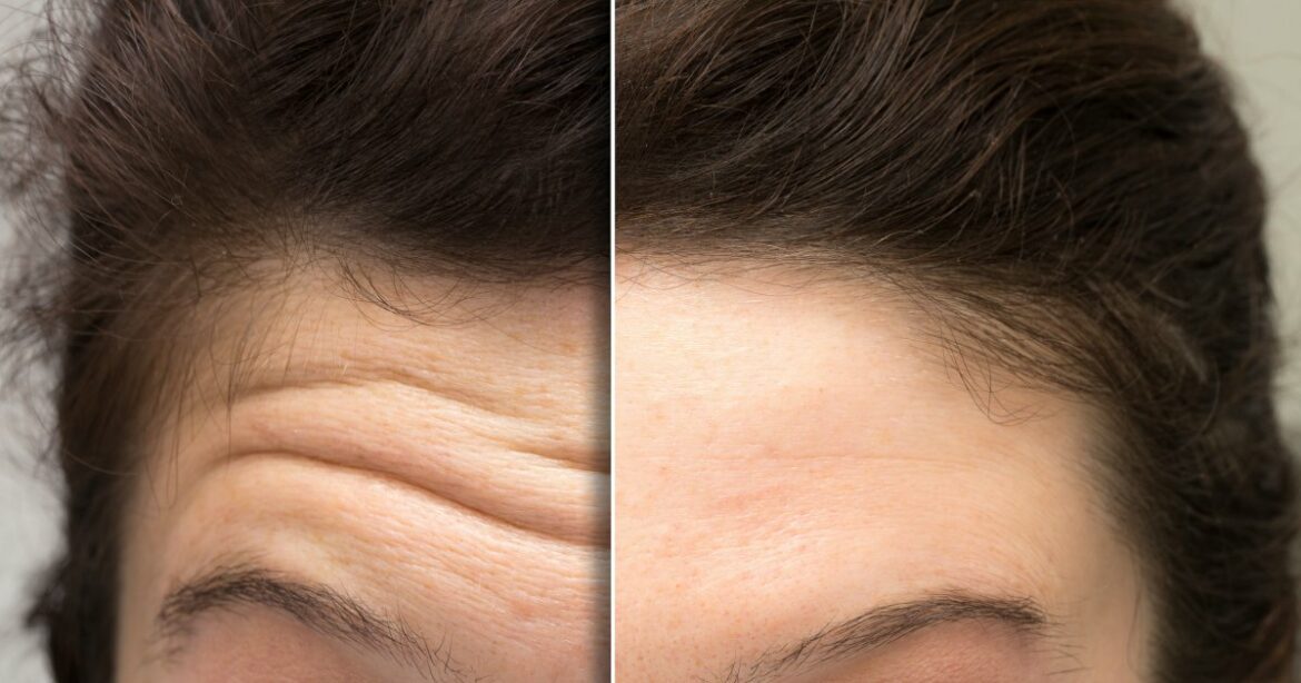 Shoppers Say This New Treatment Is Making Their Forehead Lines ‘Disappear’